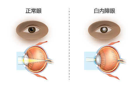 人老了都会得的白内障，王新院长告诉你该怎么治！